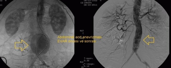 Aort damarındaki genişleme için "EVAR" tedavisi