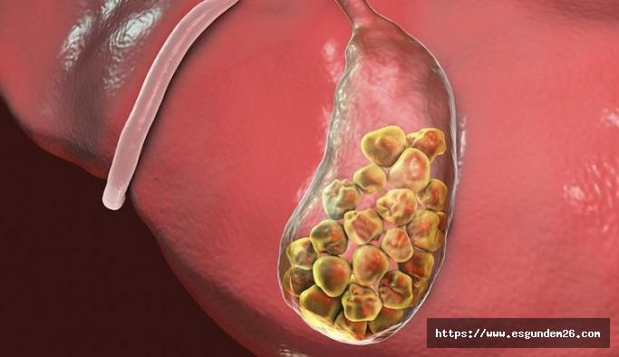 Safra Kesesi Taşı Belirtileri Nelerdir?