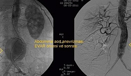 Aort damarındaki genişleme için "EVAR" tedavisi
